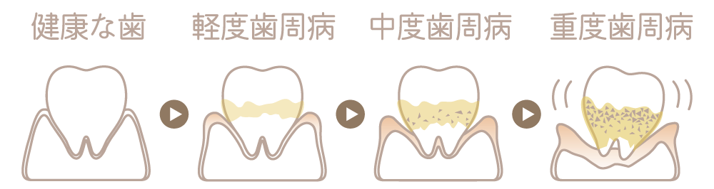 歯周病治療（歯ぐきの治療）について